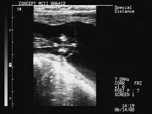 Male Fetus at 60 days